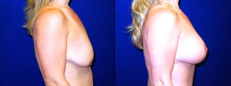 Right Profile View - Breast Augmentation with Lift