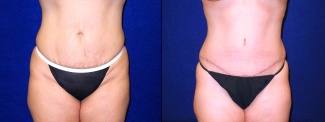 Frontal View - Tummy Tuck After Pregnancy