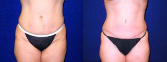 Frontal View - Tummy Tuck After Pregnancy