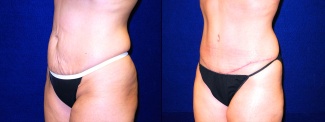 Left 3/4 View - Tummy Tuck After Pregnancy