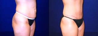 Right 3/4 View - Tummy Tuck After Pregnancy