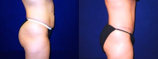 Right Profile View - Tummy Tuck After Pregnancy