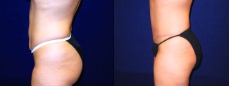 Left Profile View - Tummy Tuck After Pregnancy