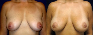 Frontal View - Breast Augmentation with Periareolar Lift - Silicone Implants