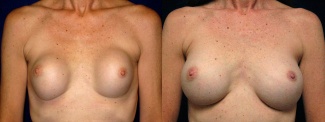 Frontal View - Breast Implant Revision - Silicone Implants