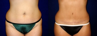 Frontal View - Tummy Tuck