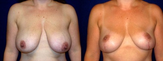 Frontal View - Breast Reduction