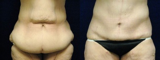 Frontal View - Circumferential Tummy Tuck After Massive Weight Loss