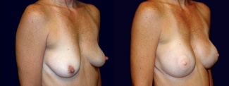 Right 3/4 View - Breast Reconstruction