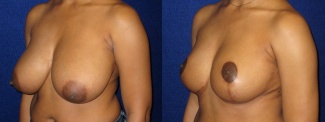 Left 3/4 View - Breast Reduction