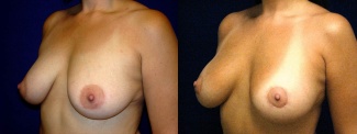 Left 3/4 View - Breast Augmentation with Periareolar Lift - Silicone Implants