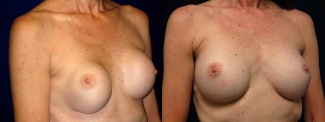 Right 3/4 View - Breast Implant Revision - Silicone Implants