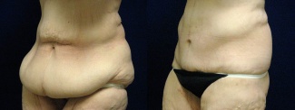 Left 3/4 View - Circumferential Tummy Tuck After Massive Weight Loss