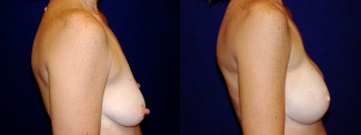 Right Profile View - Breast Reconstruction