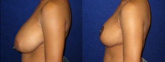 Left Profile View - Breast Reduction