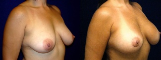 Right 3/4 View - Breast Augmentation with Periareolar Lift - Silicone Implants