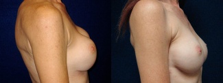 Right Profile View - Breast Implant Revision - Silicone Implants