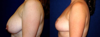 Left Profile View - Breast Reduction