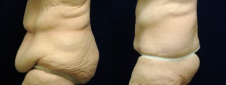 Left Profile View - Circumferential Tummy Tuck After Massive Weight Loss