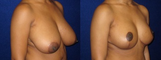 Right Profile View - Breast Reduction