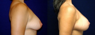 Right Profile View - Breast Augmentation with Periareolar Lift - Silicone Implants