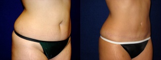 Right 3/4 View - Tummy Tuck