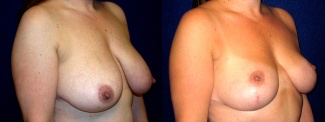 Right 3/4 View - Breast Reduction