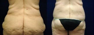 Posterior View - Circumferential Tummy Tuck After Massive Weight Loss