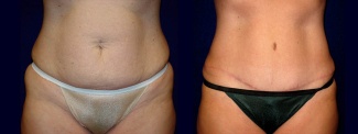 Frontal View - Tummy Tuck and Liposuction of Hips After Pregnancy