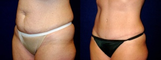 Left 3/4 View - Tummy Tuck and Liposuction of Hips After Pregnancy
