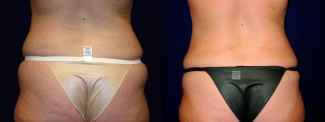 Back View - Tummy Tuck and Liposuction of Hips After Pregnancy