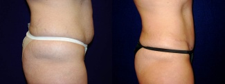 Right Profile View - Tummy Tuck and Liposuction of Hips After Pregnancy