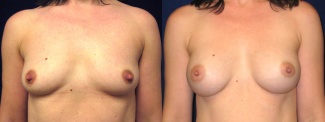 Frontal View - Breast Augmentation - Silicone Implants