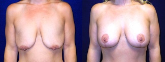Frontal View - Breast Augmentation with Periareolar Lift - Silicone Implants