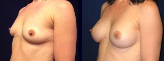 Left 3/4 View - Breast Augmentation - Silicone Implants