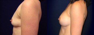 Left Profile View - Breast Augmentation - Silicone Implants