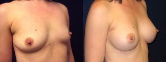 Right 3/4 View - Breast Augmentation - Silicone Implants