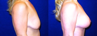 Right Profile View - Breast Augmentation with Periareolar Lift - Silicone Implants