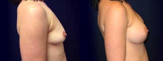 Right Profile View - Breast Augmentation - Silicone Implants