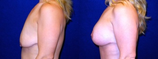 Left Profile View - Breast Augmentation with Periareolar Lift - Silicone Implants