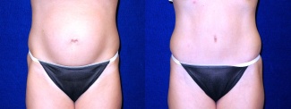 Frontal View - Tummy Tuck