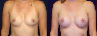 Frontal View - Breast Augmentation - Silicone Implants