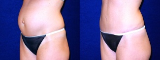 Left 3/4 View -Tummy Tuck