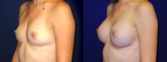 Left 3/4 View - Breast Augmentation - Silicone Implants