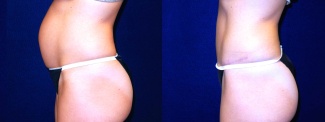 Left Profile View -Tummy Tuck