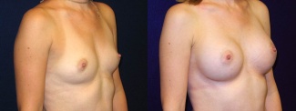 Right 3/4 View - Breast Augmentation - Silicone Implants