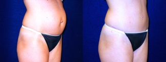 Right 3/4 View - Tummy Tuck