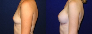 Left Profile View - Breast Augmentation - Silicone Implants