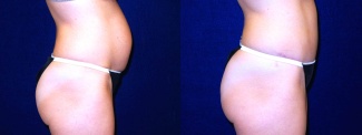 Right Profile View - Tummy Tuck