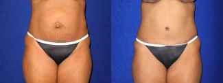 Frontal View - Tummy Tuck After Pregnancy